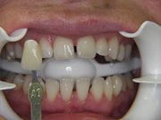 Whitening2 A